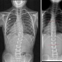 Treating Scoliosis
